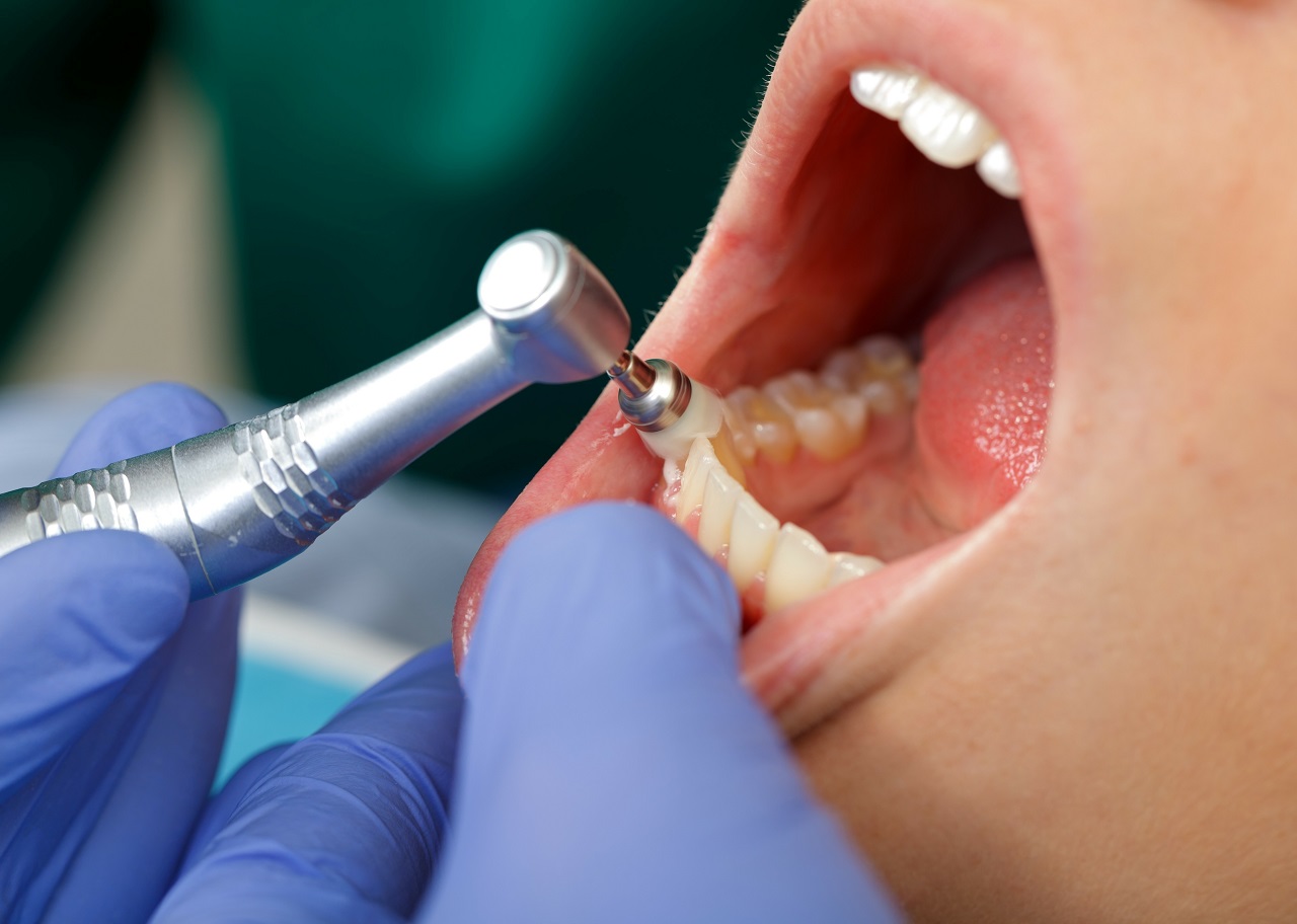 Jakie formy leczenia zębów oferowane są przez lekarzy stomatologów?